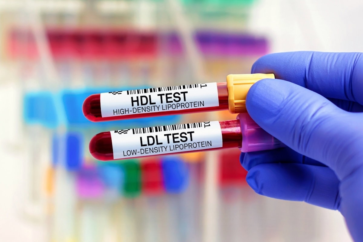 Colesterol HDL Bajo: Síntomas, Causas y Riesgos para la Salud