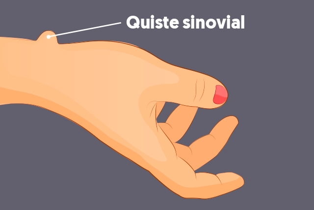 Quiste sinovial: síntomas, tratamiento y áreas afectadas (pie, rodilla, muñeca)