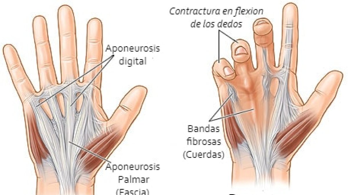 Retracciones en la palma: Entiende la enfermedad de Dupuytren