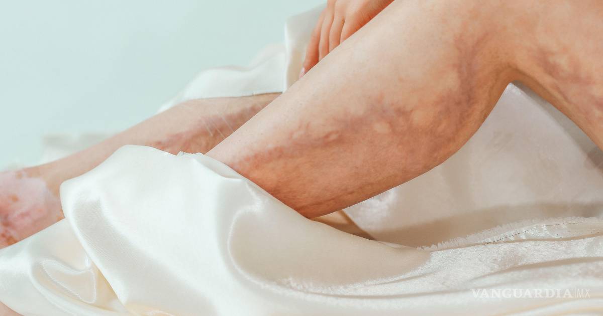 Venas varicosas: ¿Son peligrosas para tu salud?